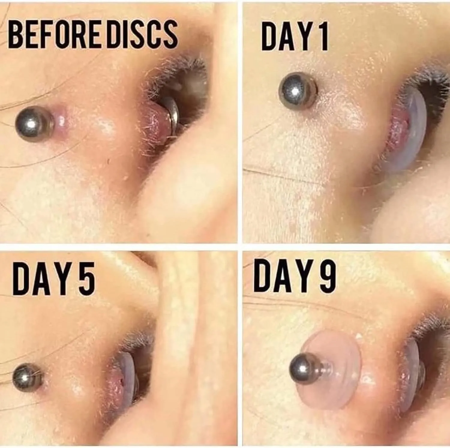 Bloomfall Clear Piercing Disc for Nose Piercing Bump Treatment, Silicone Earrings for Keloids Healing Pads